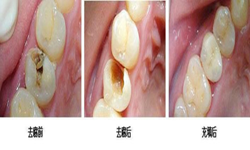 补牙