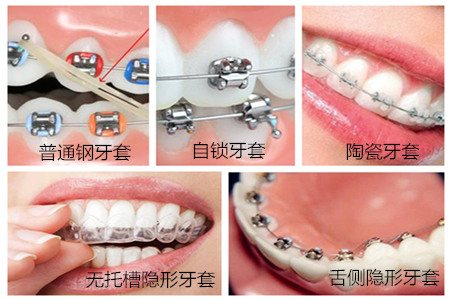 牙套