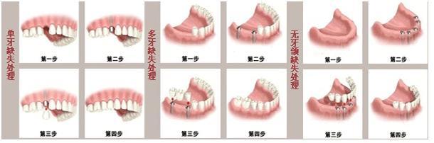 苏州美奥口腔，种牙的过程