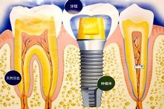 种植牙.jpg